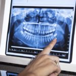Temporomandibular Joint Disorder Causes and Treatments 2 Dentist analyzing a panoramic dental X-ray on a digital screen
