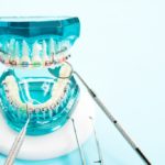 Rubber Bands For Braces: Helpful Tips And Tricks 8 Orthodontic model and dentist tool
