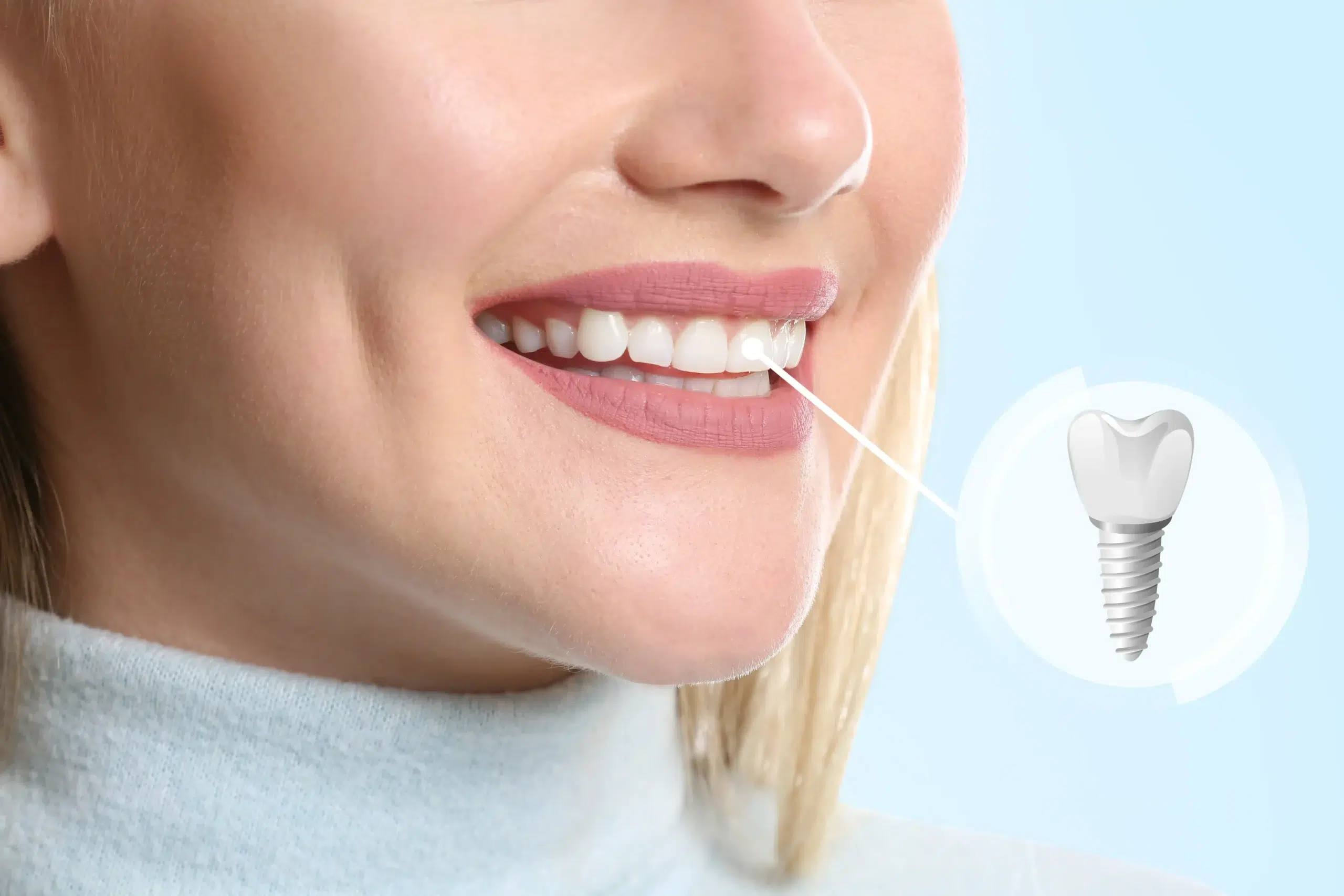 dental implant procedure scaled